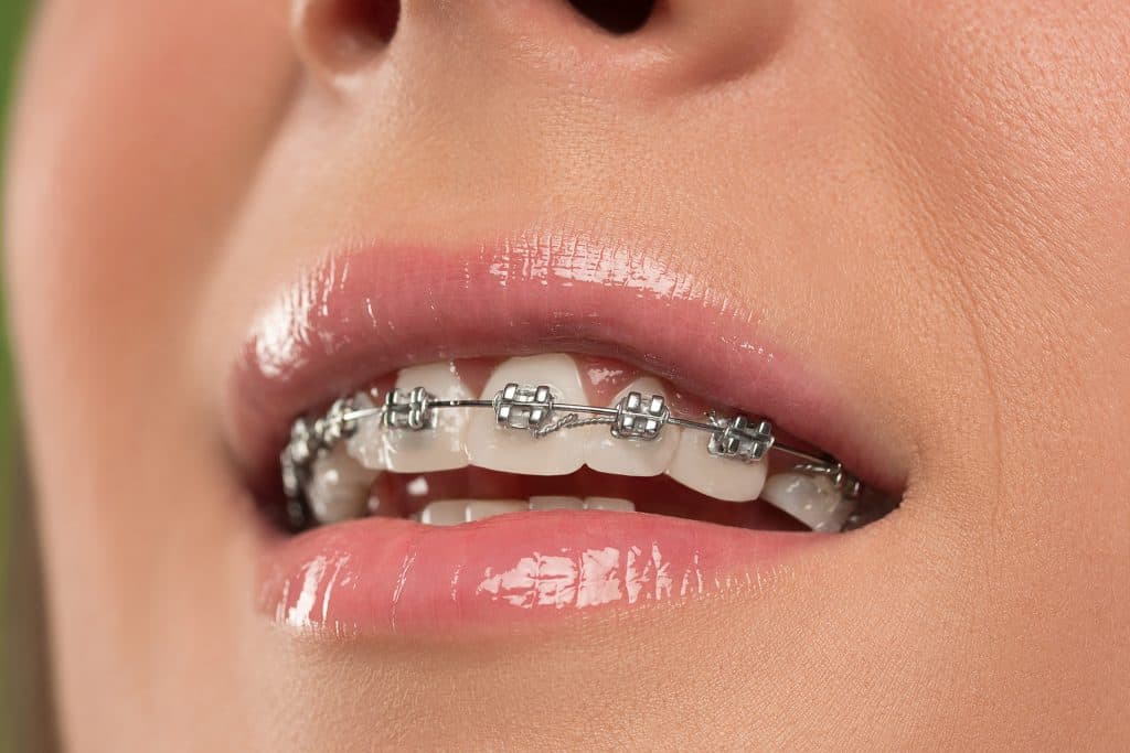 woman with braces on teeth