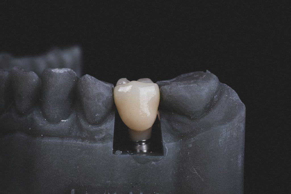 tooth mould showing a dental implant