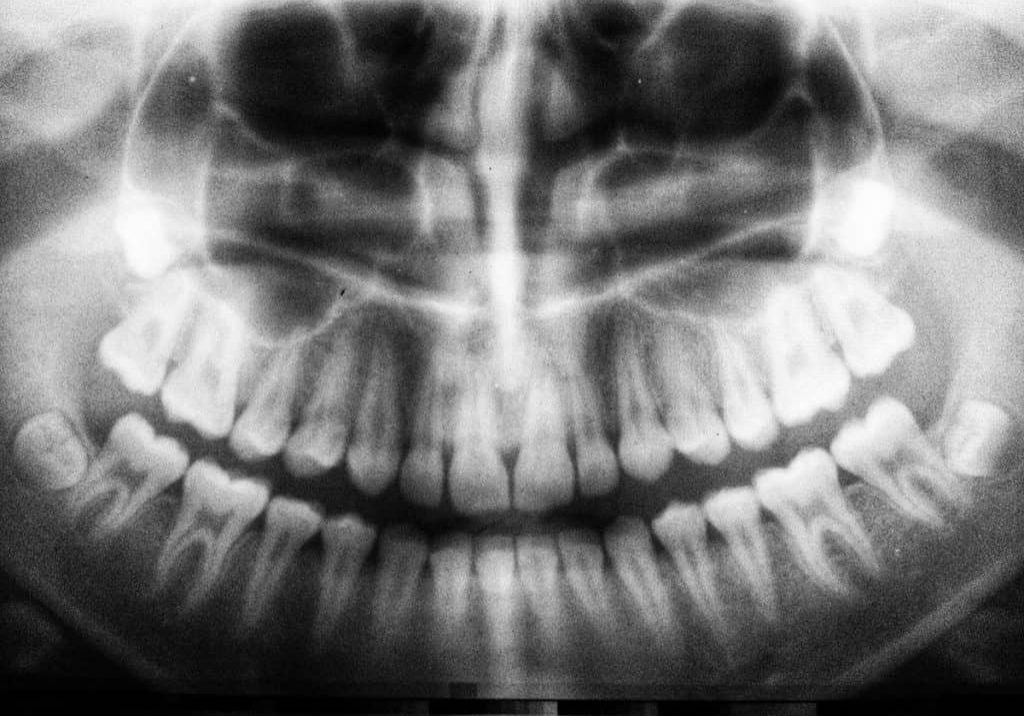 Dental-X-ray