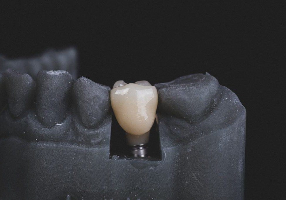 tooth mould showing a dental implant