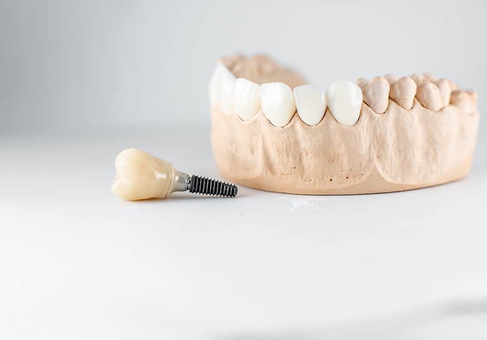 Close-up on plaster model of artificial jaw and dental implant on the white background. Concept of prosthetics and implantation in dentistry